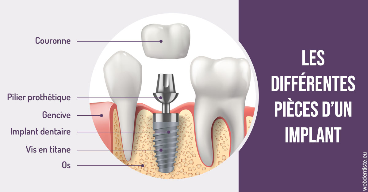 https://www.clinique-dentaire-elbelghiti.com/Les différentes pièces d’un implant 2