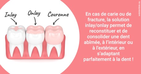 https://www.clinique-dentaire-elbelghiti.com/L'INLAY ou l'ONLAY 2