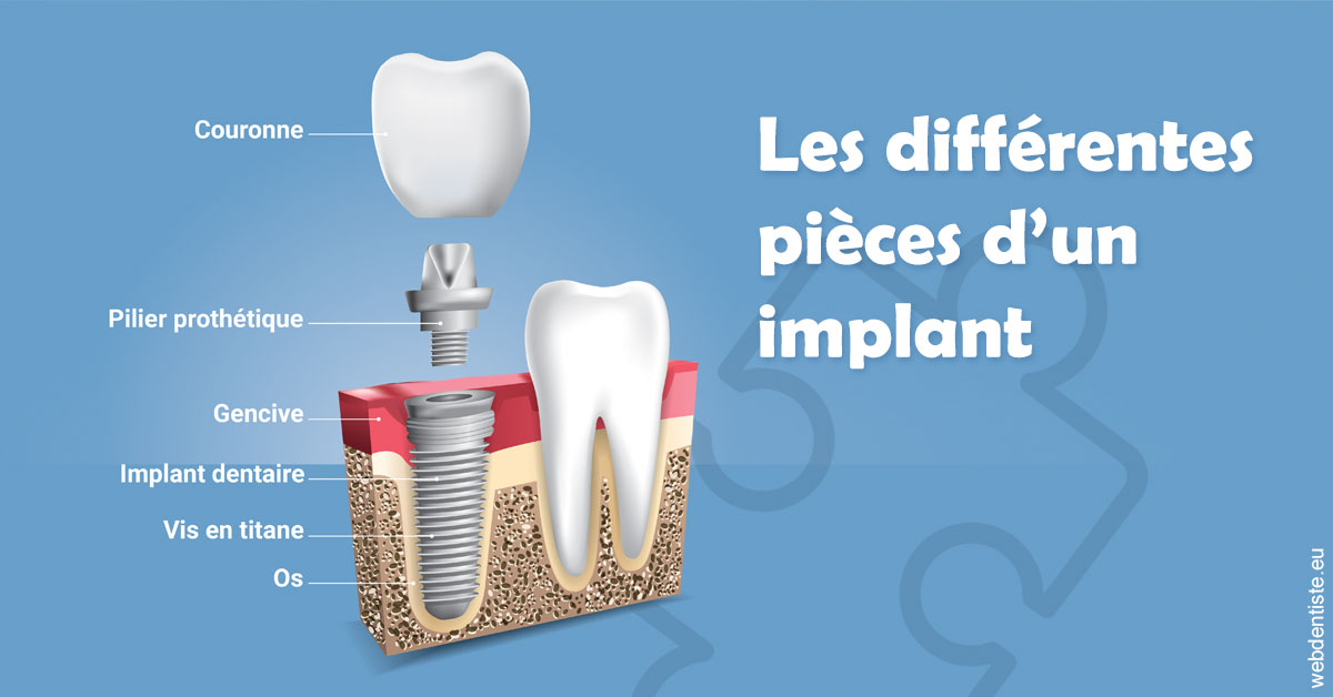 https://www.clinique-dentaire-elbelghiti.com/Les différentes pièces d’un implant 1