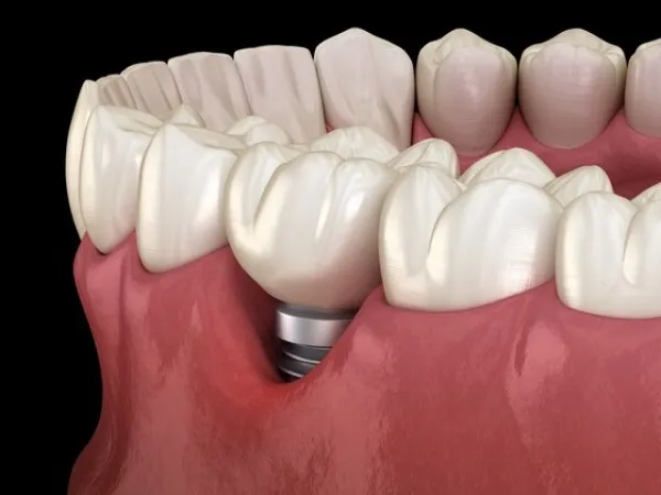 Peri-implantite
