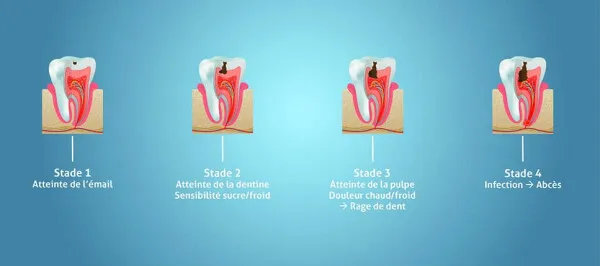 Caries et soins des caries